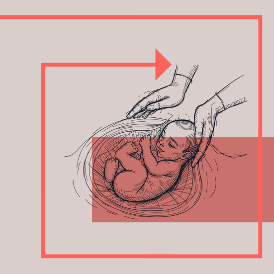 Kejsersnit: Tegning af baby der bliver løftet ud af en mave